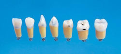 A27 #36N MOD Moderate Composite Resin Teeth with Caries Kilgore Teeth Nissin-A27#36N-Kilgore Int