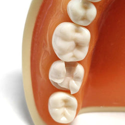 A21-LL74 (3.7) 18 MOD-B Pre-Prepared Teeth Kilgore Nissin