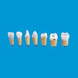 A27#11F 1.1 MD Composite Resin Teeth with Caries Kilgore Teeth Nissin-A27#11F-Kilgore Int