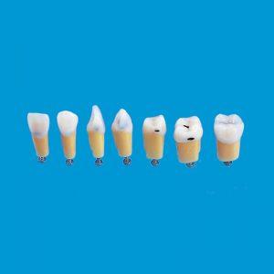 A27#16C 1.6 Class I - 4 small caries Composite Resin Teeth with Caries Kilgore Teeth Nissin-A27#16C-Kilgore Int