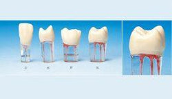 S12 #3 (1.6) Upper Right 1st Molar Endodontic Teeth with Transparent Root-S12#3-Kilgore Int